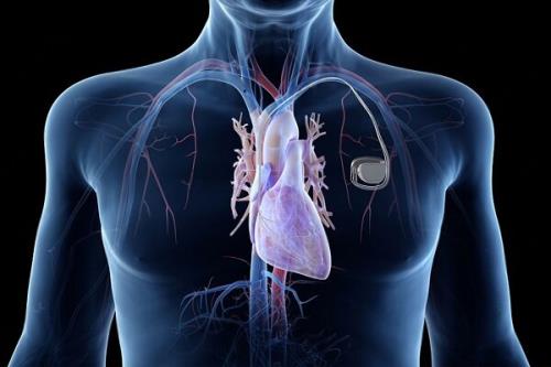 طراحی ضربان ساز قلبی که تا ۳۰۰ سال در بدن کار می کند!