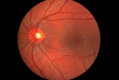 قطره ابداعی محقق ایرانی التهاب چشم را درمان می کند